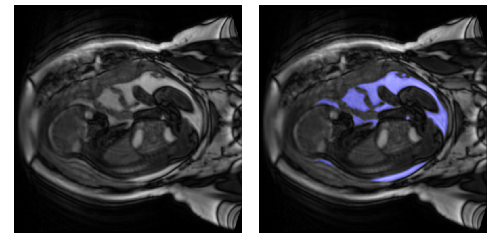 Example slice of an input exam along with its target amniotic fluid segmentation.